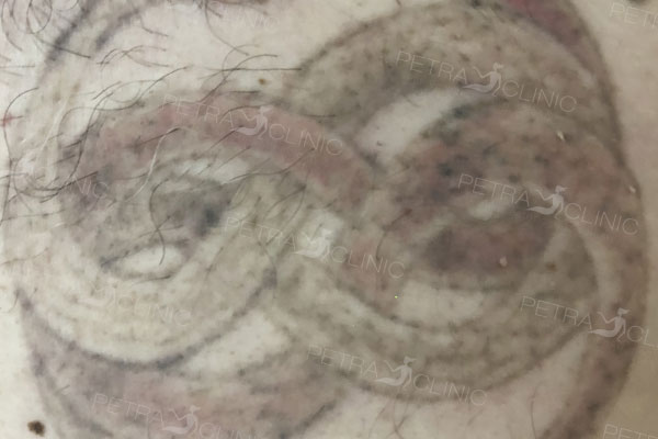 Odstranění tetování po 2 ošetřeních
