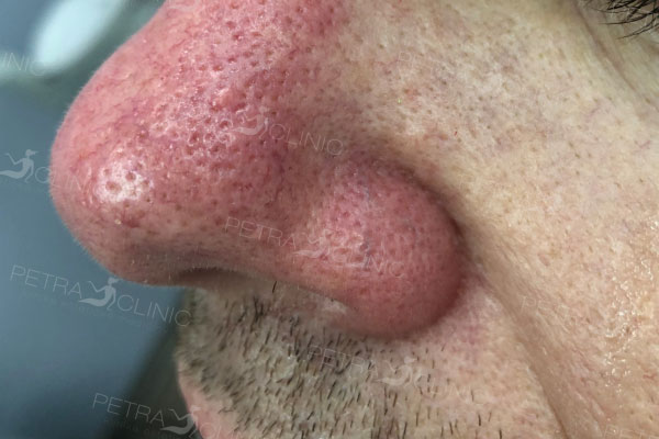 Laserová redukce červených žilek v oblasti nosu